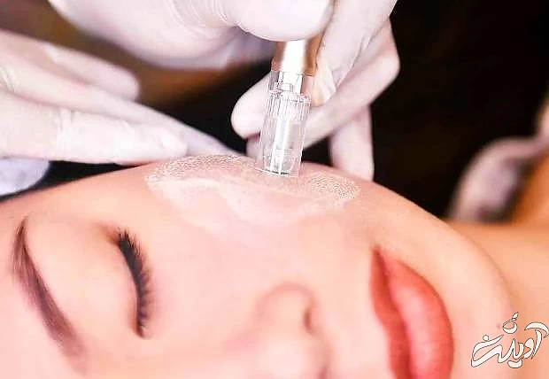 روش انجام مزووایت